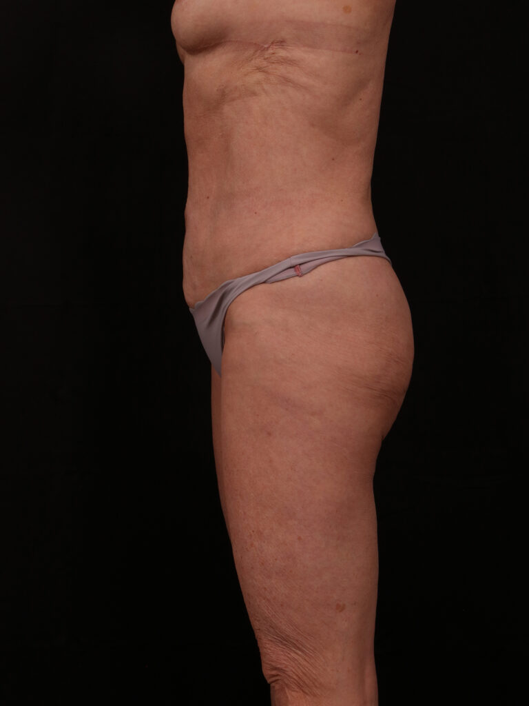 After Image: Reverse Abdominoplasty - left-side