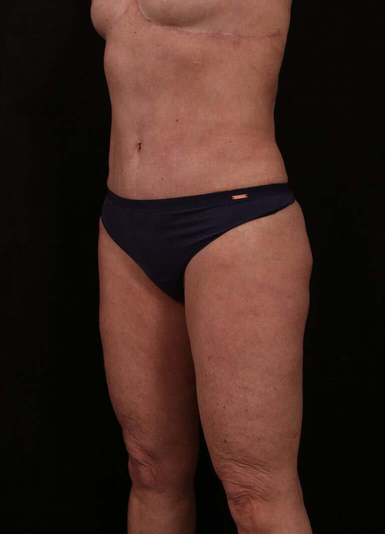 Before Image: Reverse Abdominoplasty - left-front-oblique