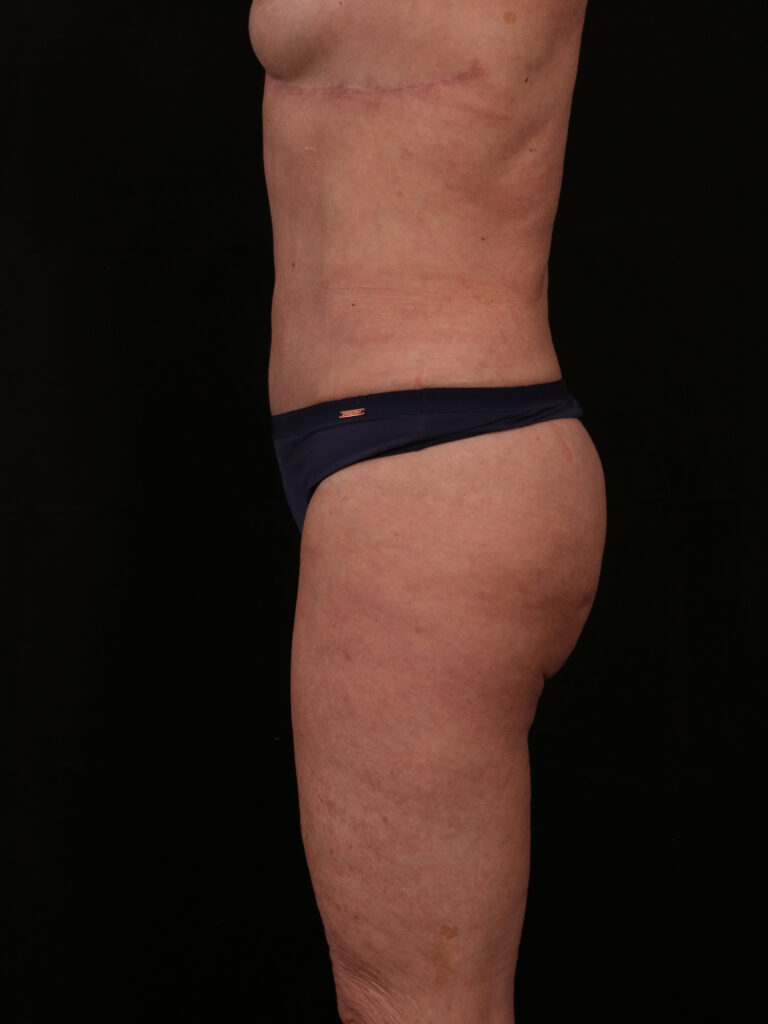 Before Image: Reverse Abdominoplasty - left-side