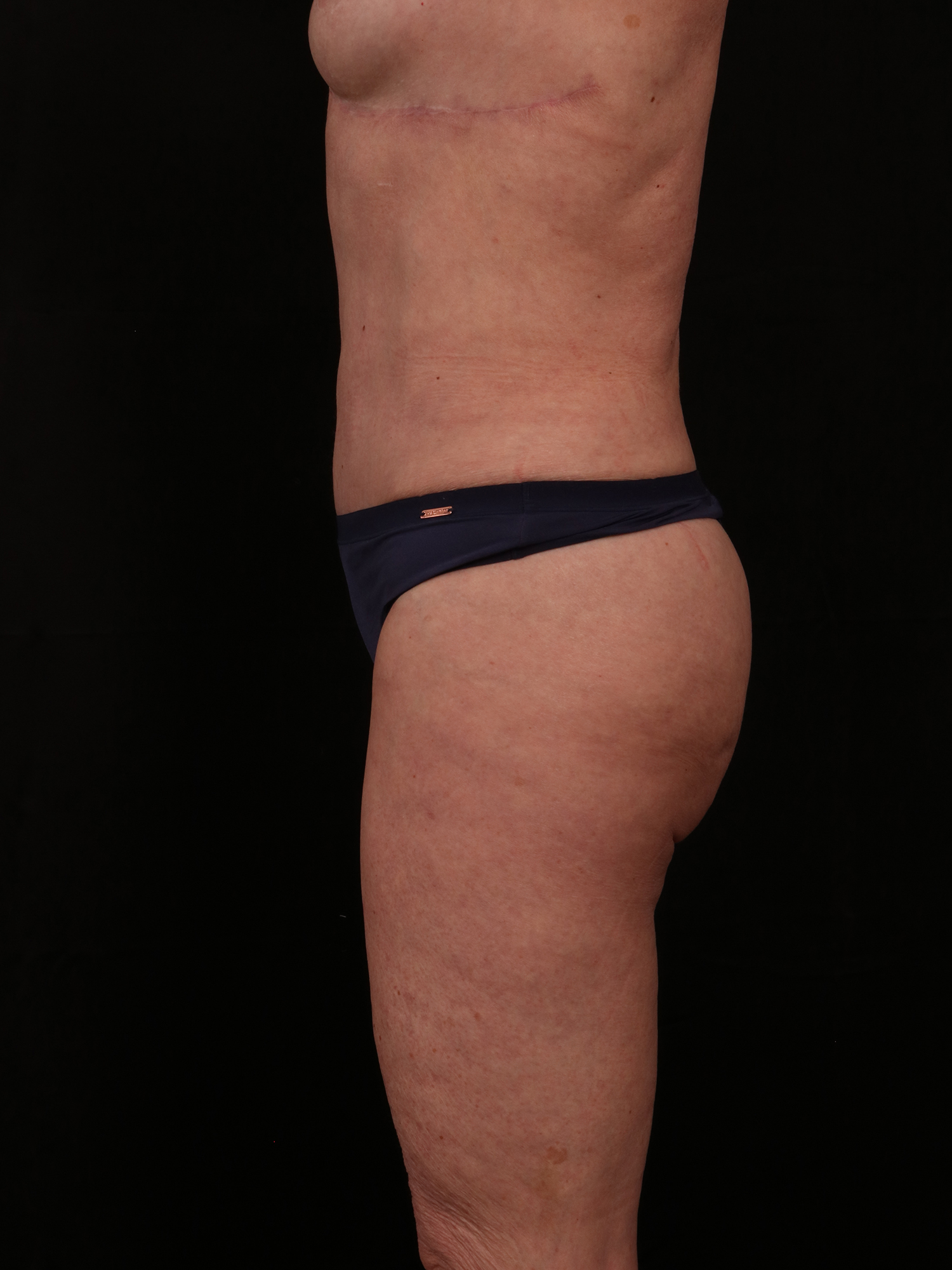 After Image: Reverse Abdominoplasty - left-side