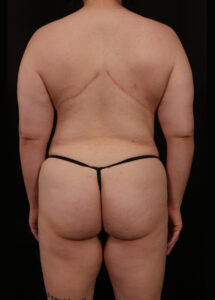 After Image: Bra Strap Excision
