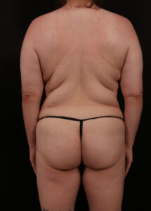 Before Image: Bra Strap Excision