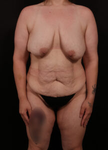 Before Image: Mommy Makeover
