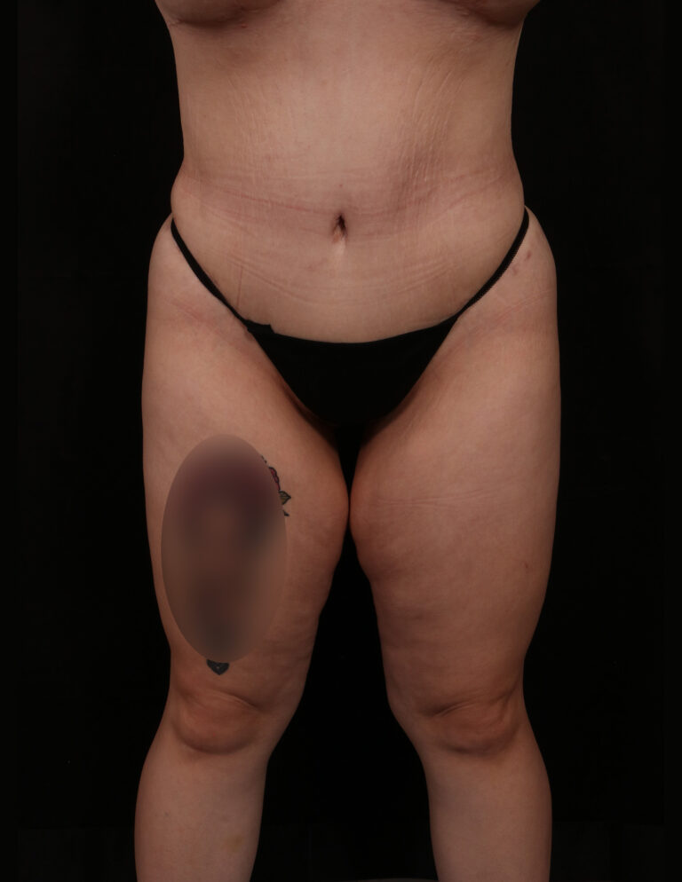 After Image: Abdominoplasty - front