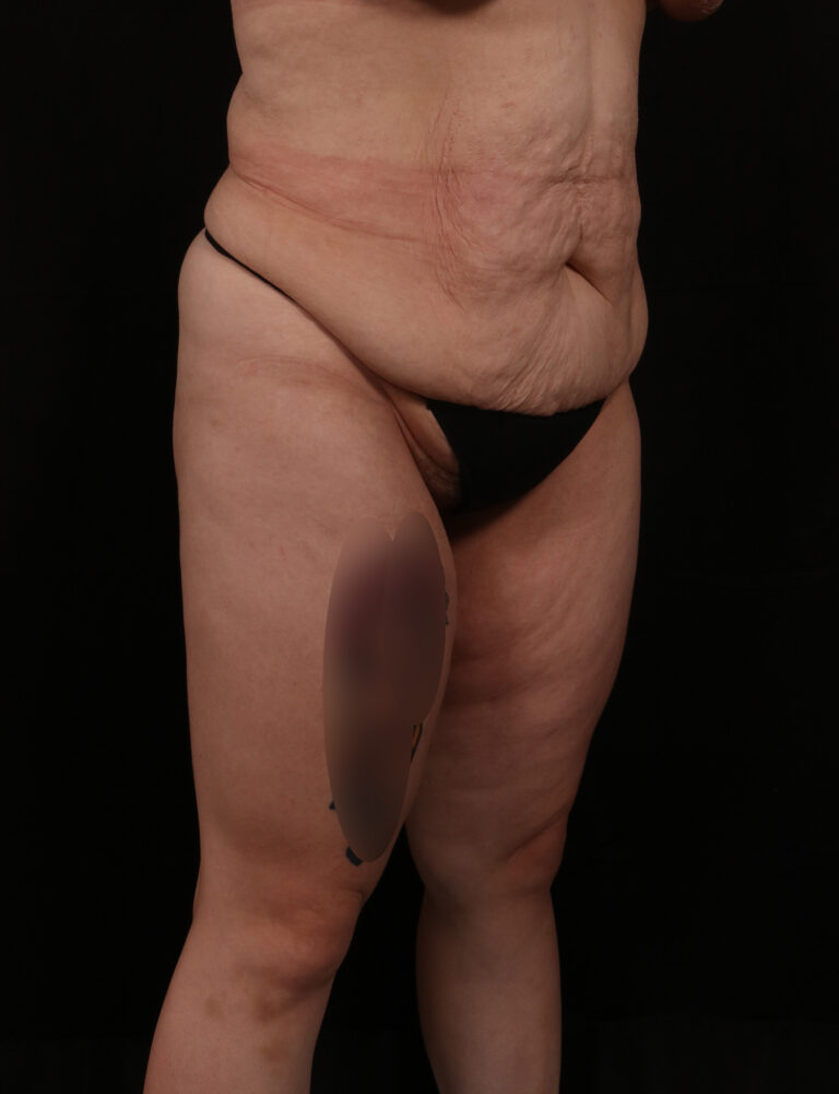 Before Image: Abdominoplasty - right-front-oblique