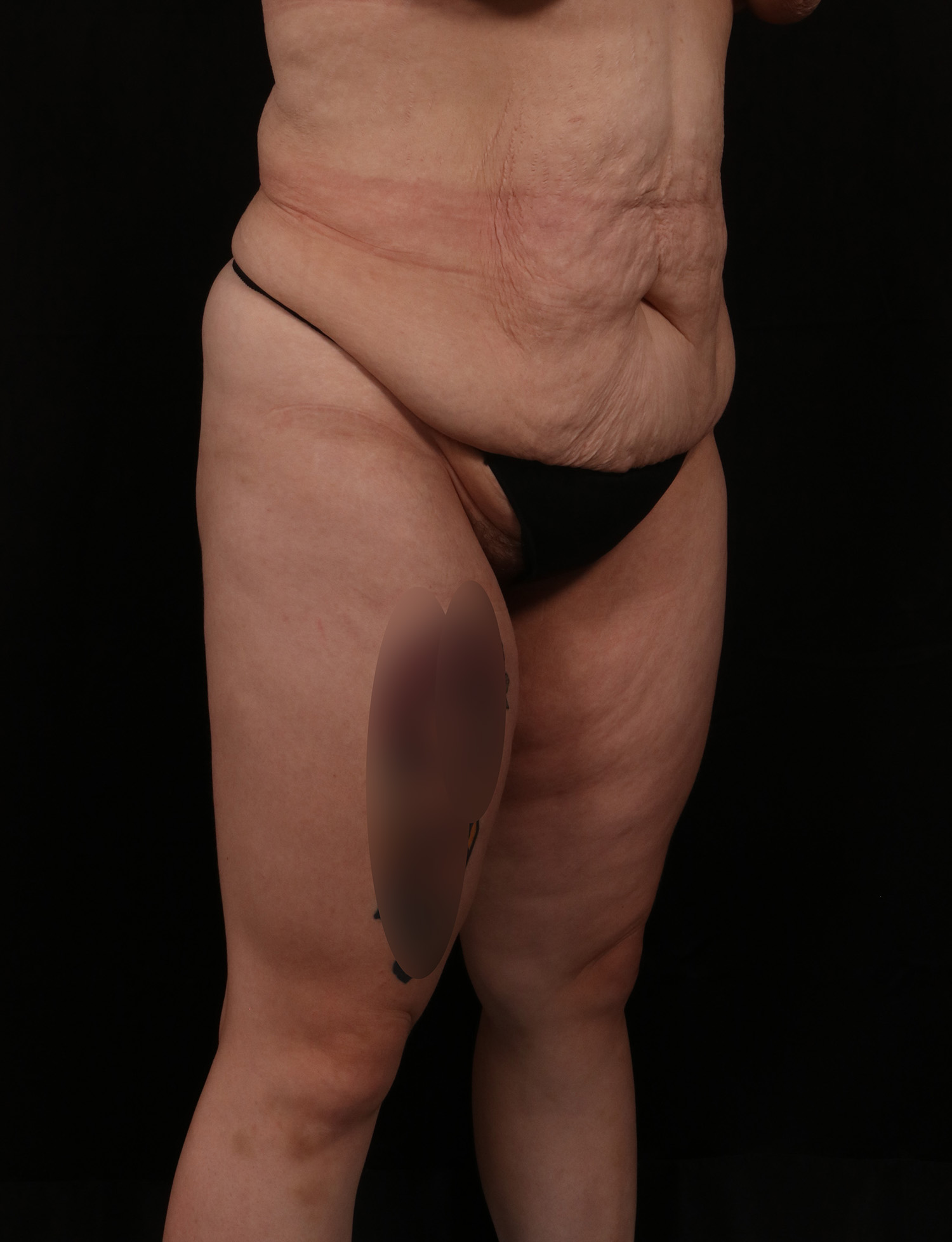 Before Image: Abdominoplasty - right-front-oblique