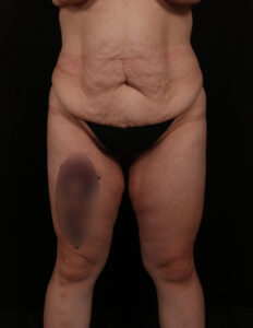 Before Image: Abdominoplasty