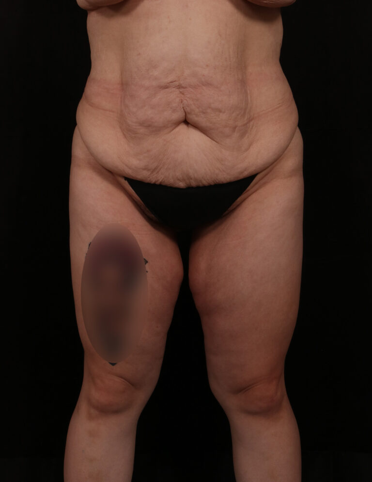 Before Image: Abdominoplasty - front