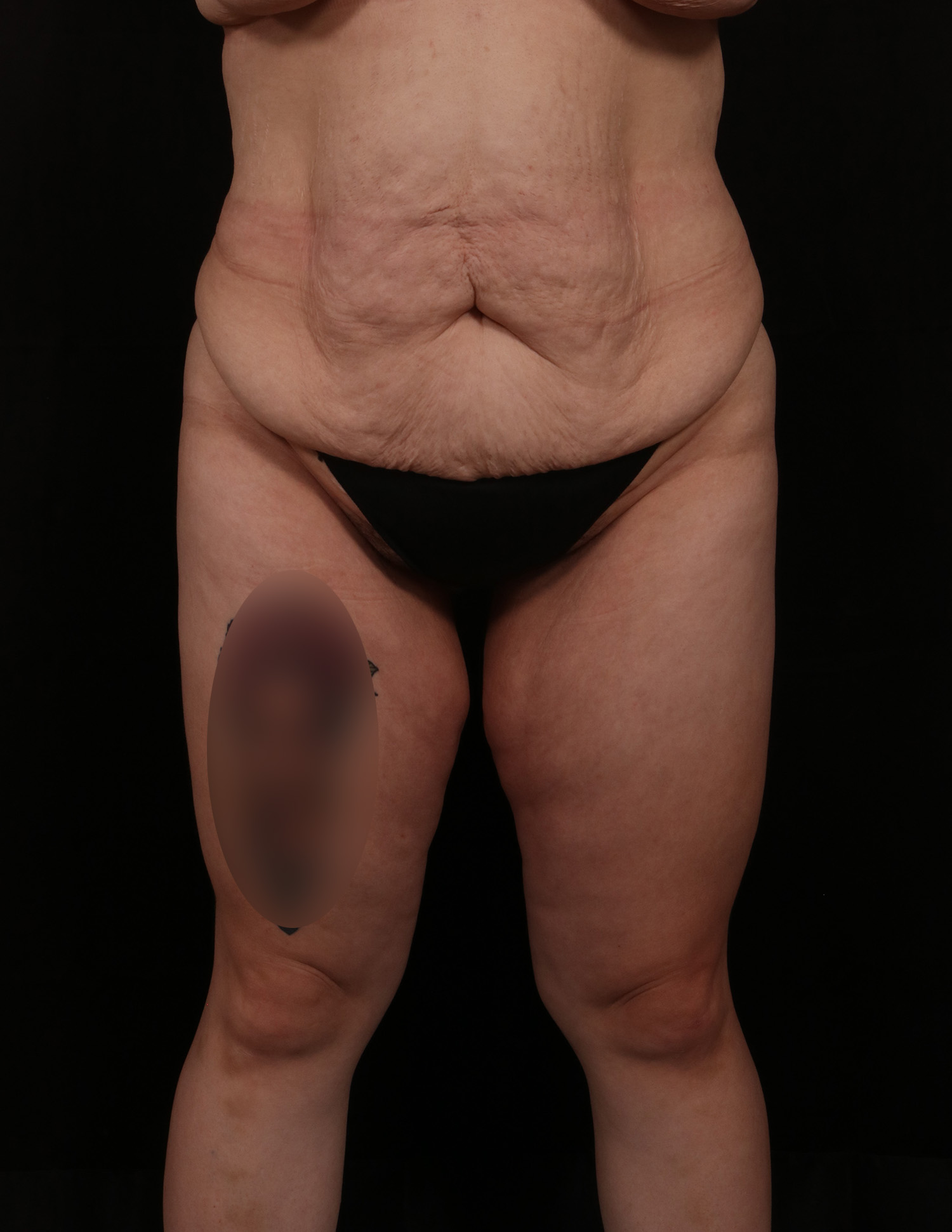 Before Image: Abdominoplasty - front