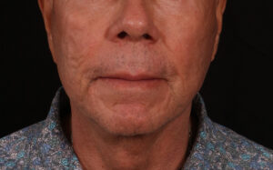 After Image: Lower Facelift