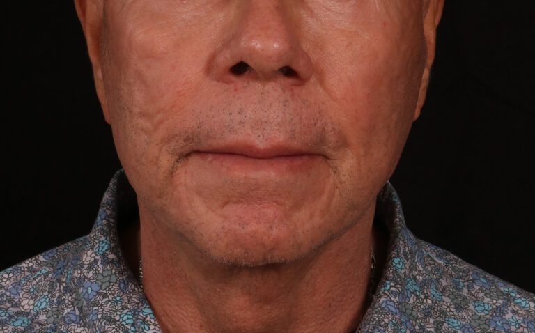 After Image: Lower Facelift - front