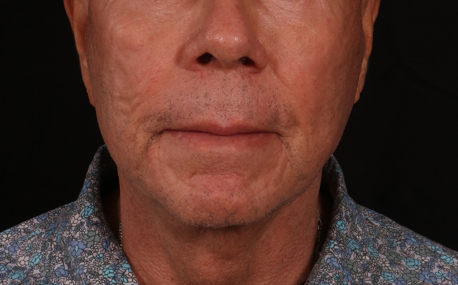 After Image: Lower Facelift - front