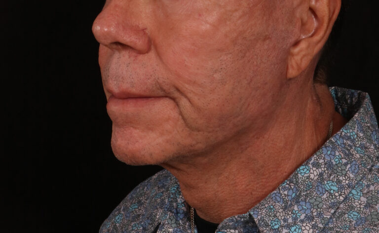 After Image: Lower Facelift - left-front-oblique