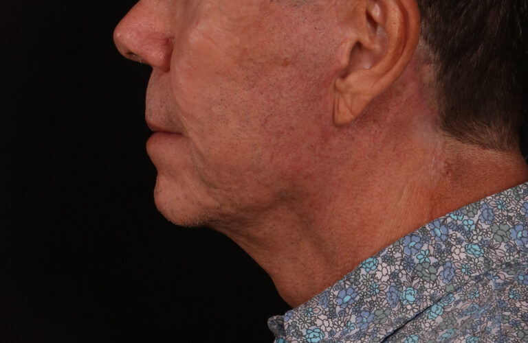 After Image: Lower Facelift - left-side
