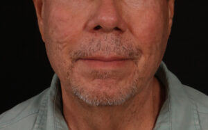 Before Image: Lower Facelift