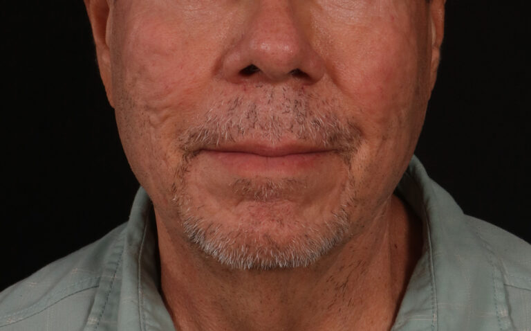 Before Image: Lower Facelift - front