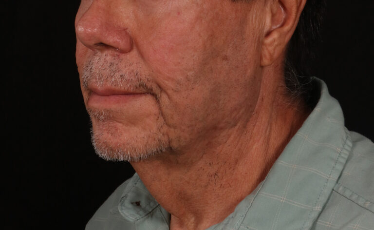 Before Image: Lower Facelift - left-front-oblique