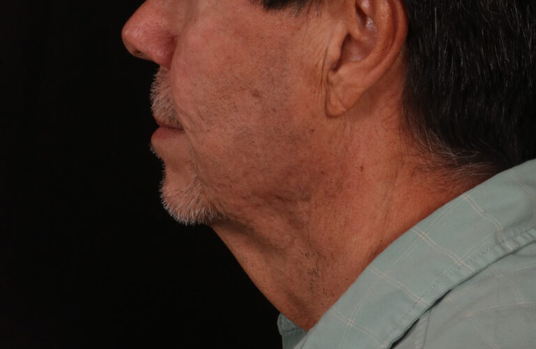 Before Image: Lower Facelift - left-side