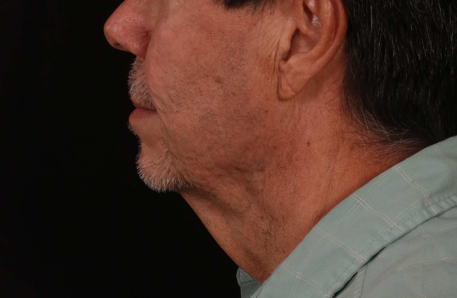 Before Image: Lower Facelift - left-side