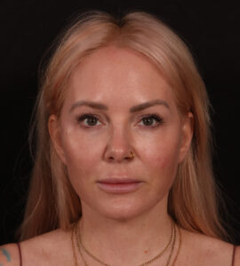 After Image: Lower Facelift