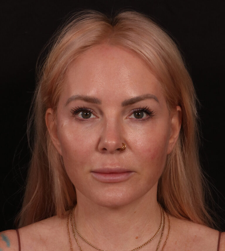After Image: Lower Facelift - front