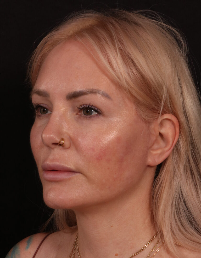 After Image: Lower Facelift - left-front-oblique