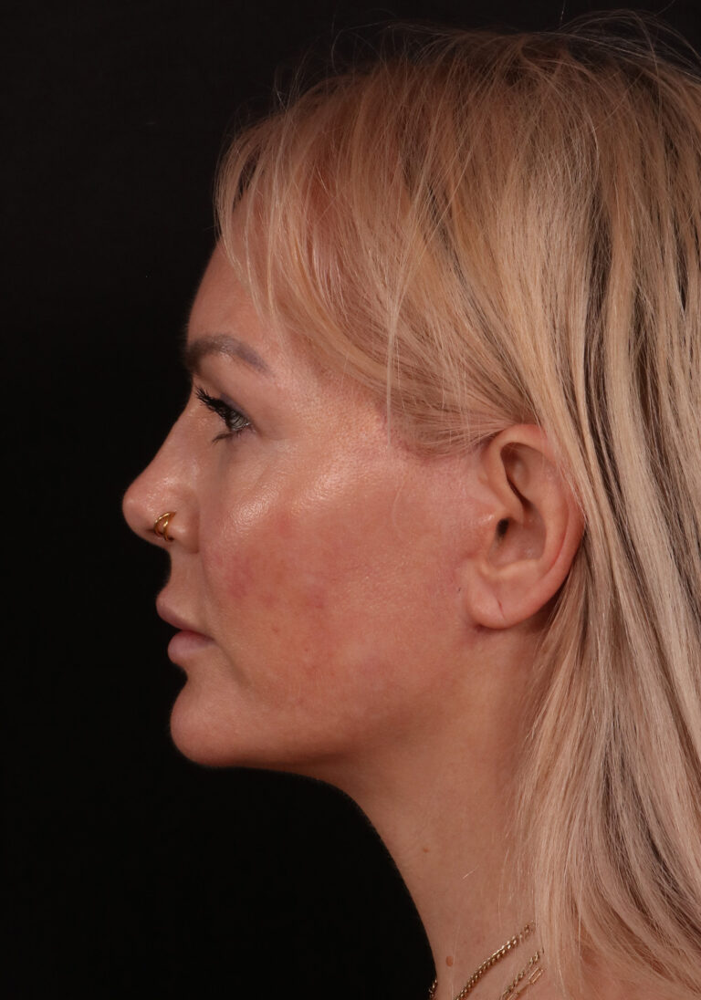 After Image: Lower Facelift - left-side
