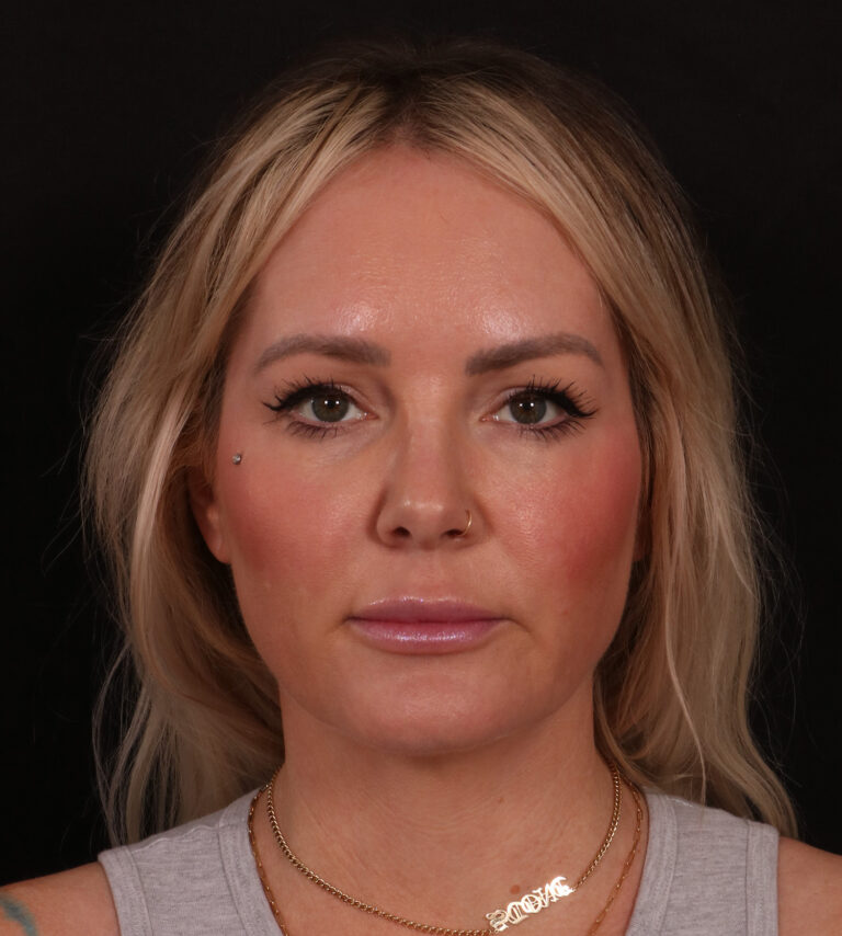 Before Image: Lower Facelift - front