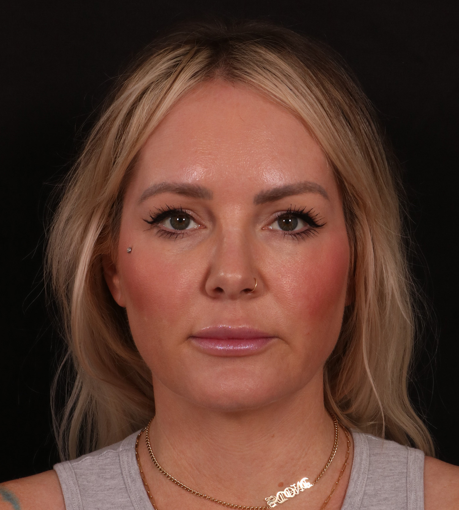 Before Image: Lower Facelift - front