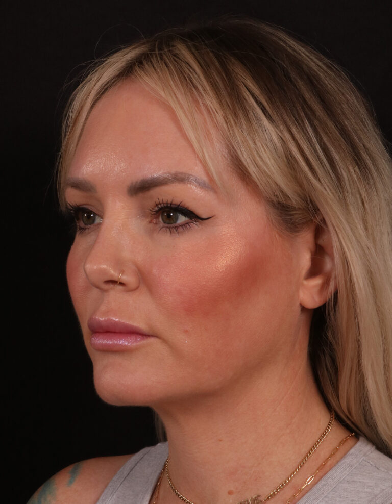 Before Image: Lower Facelift - left-front-oblique