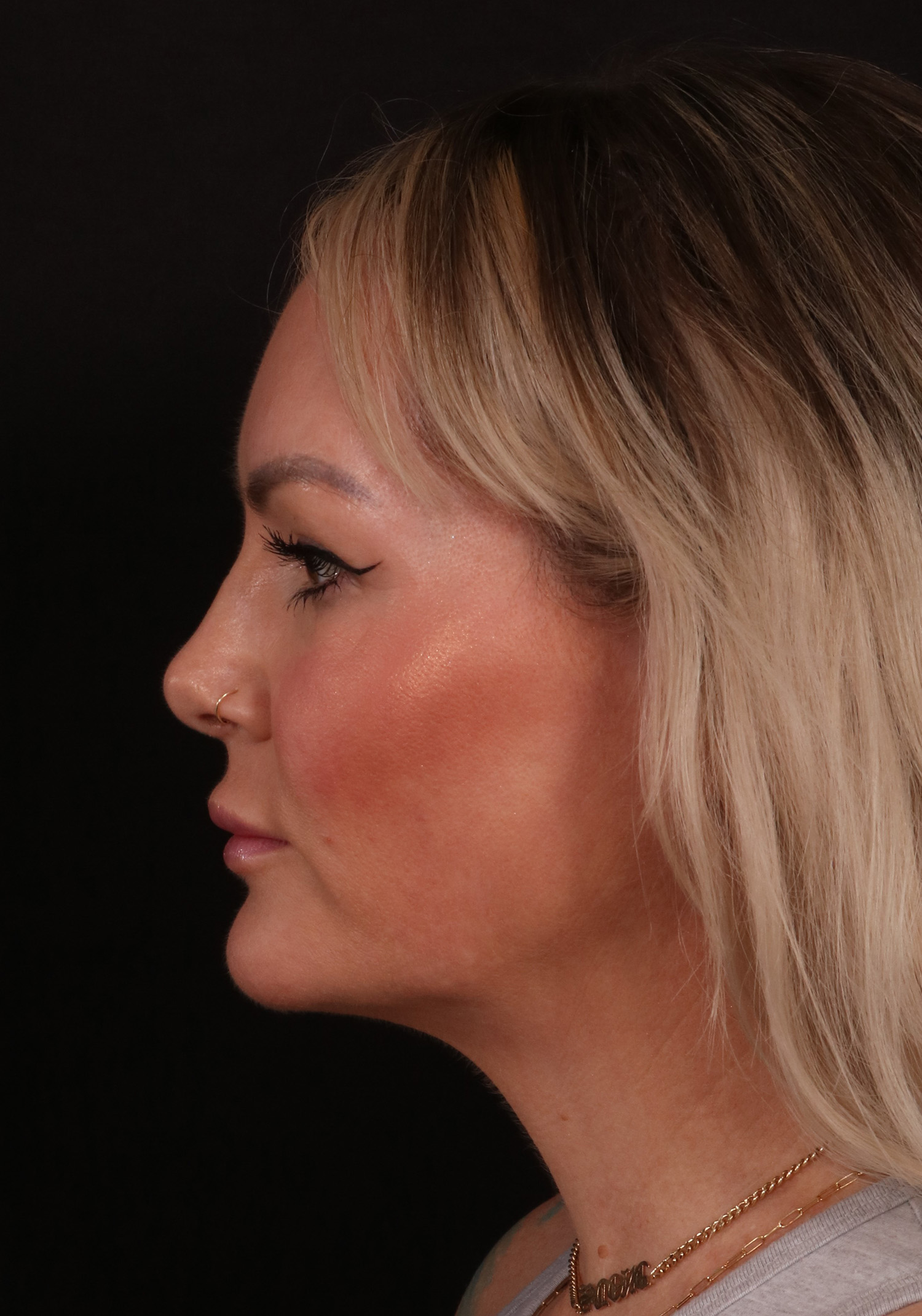 Before Image: Lower Facelift - left-side
