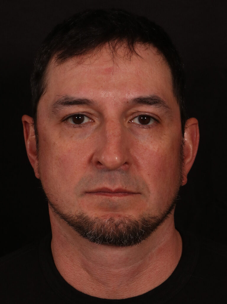 After Image: Lower Facelift and Buccal Fat Removal - front