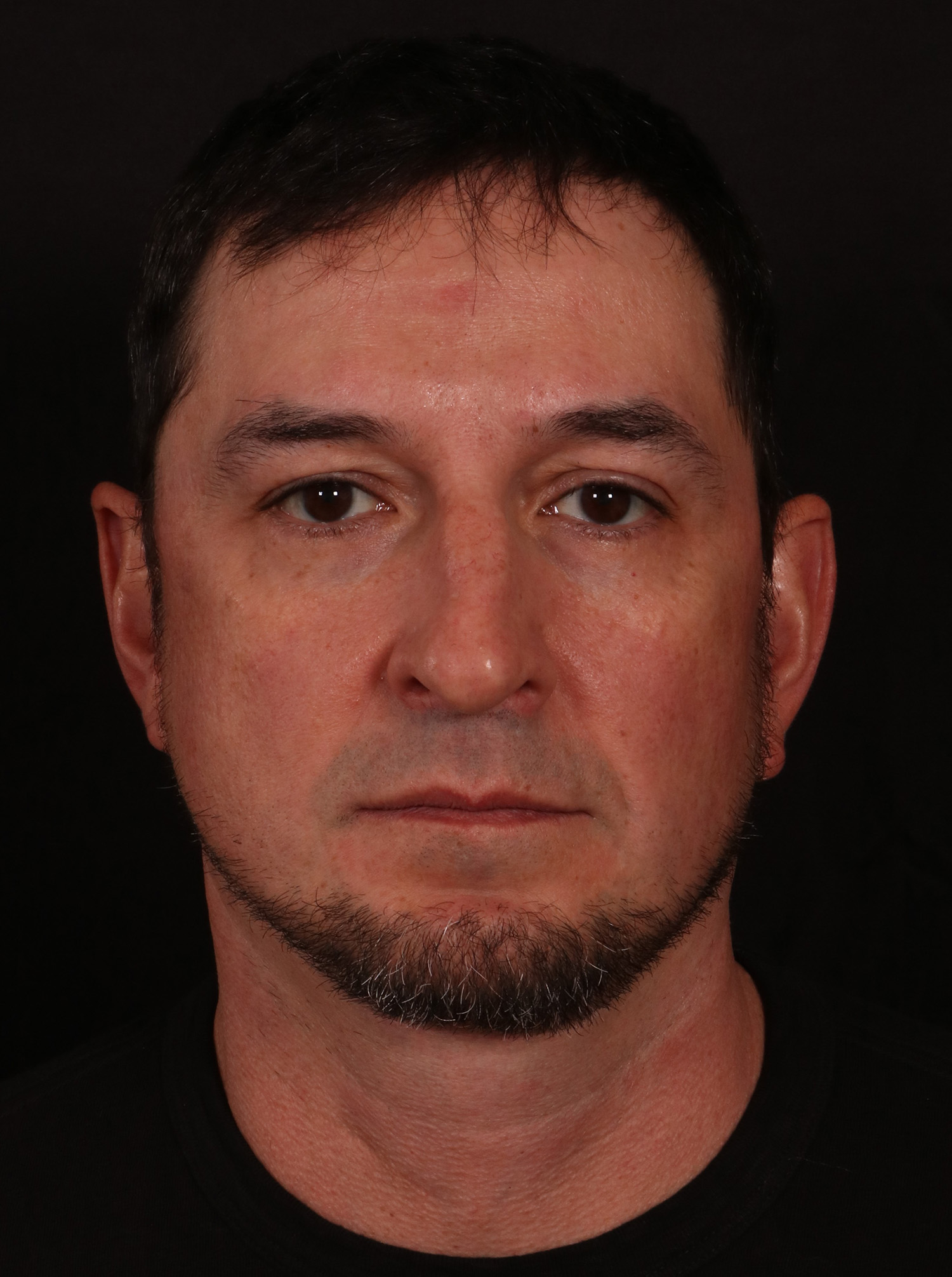 After Image: Lower Facelift and Buccal Fat Removal - front