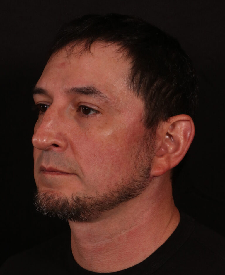 After Image: Lower Facelift and Buccal Fat Removal - left-front-oblique