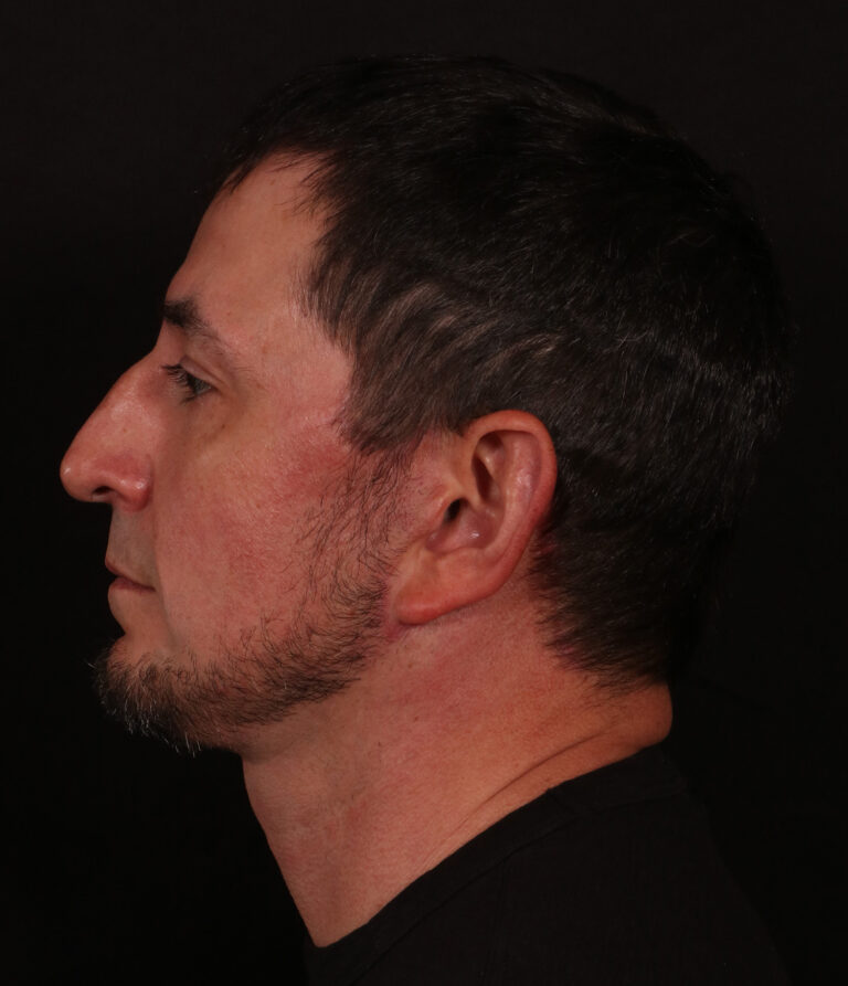 After Image: Lower Facelift and Buccal Fat Removal - left-side