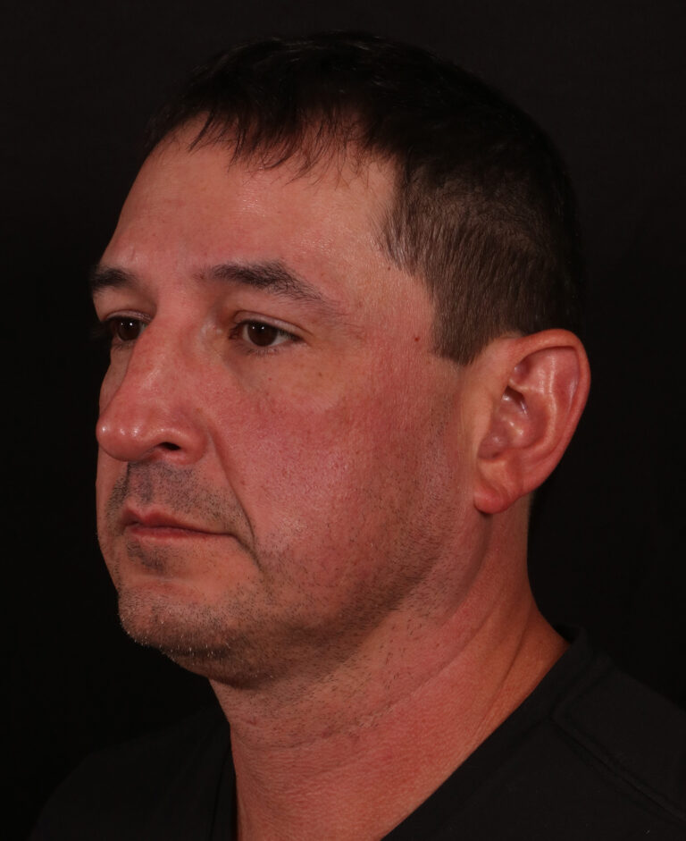 Before Image: Lower Facelift and Buccal Fat Removal - left-front-oblique