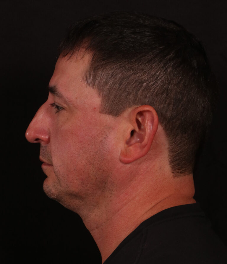 Before Image: Lower Facelift and Buccal Fat Removal - left-side