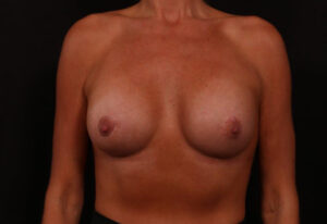 After Image: Breast Augmentation With Peri Areolar Lift