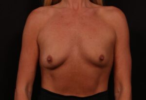 Before Image: Breast Augmentation With Peri Areolar Lift
