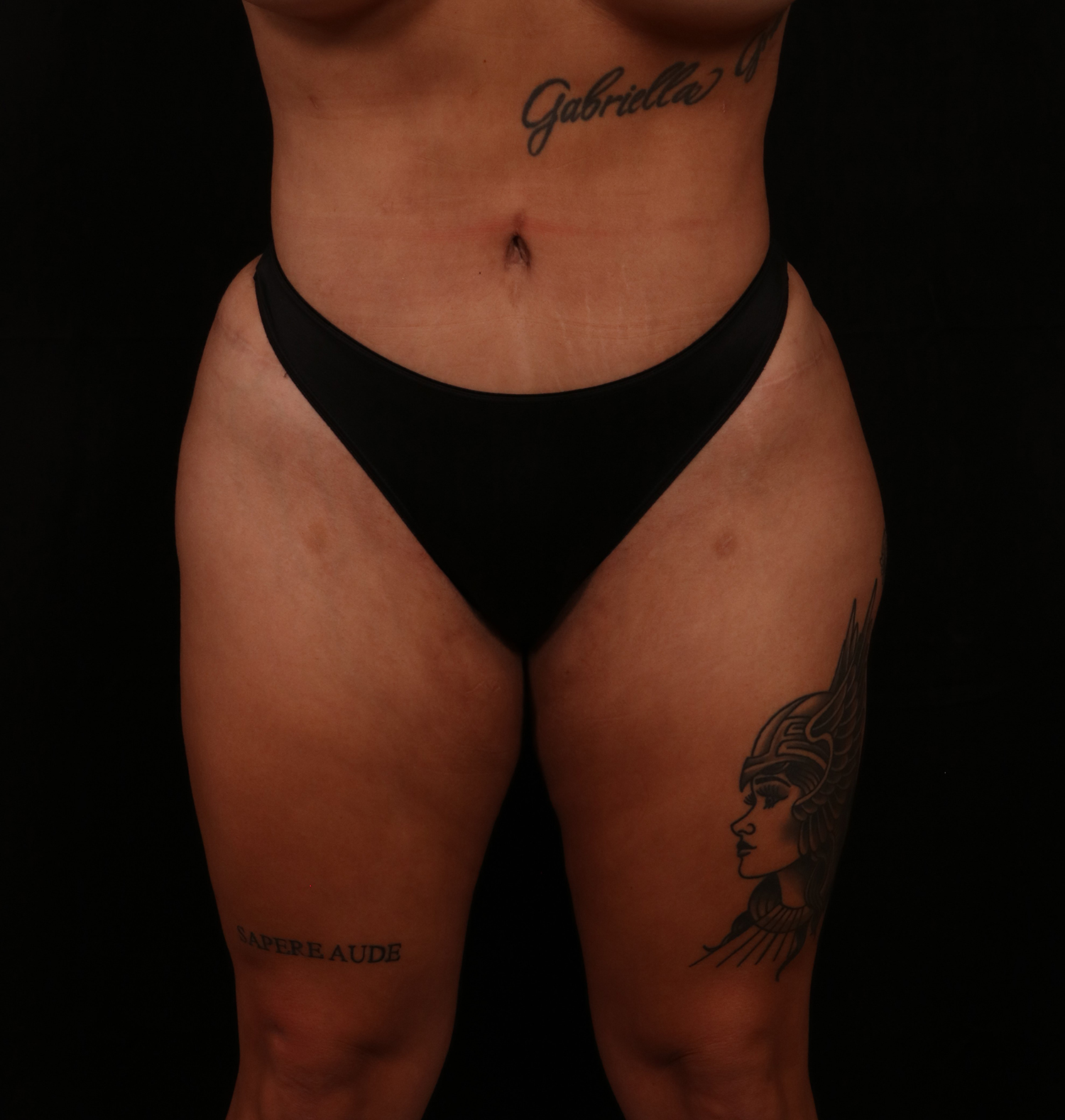 After Image: Tummy Tuck - front