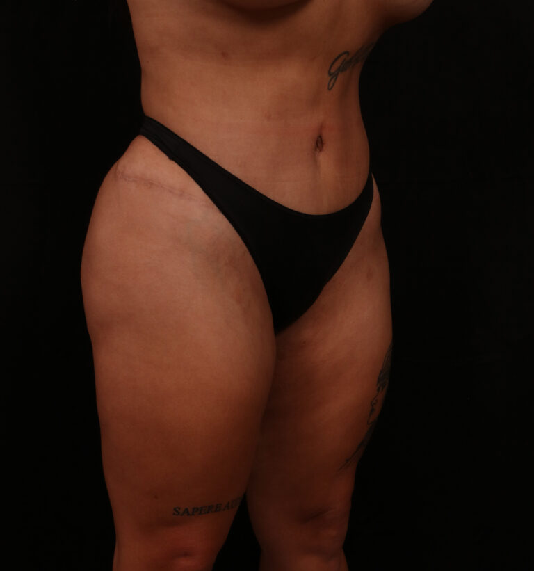 After Image: Tummy Tuck - right-front-oblique
