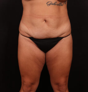Before Image: Tummy Tuck