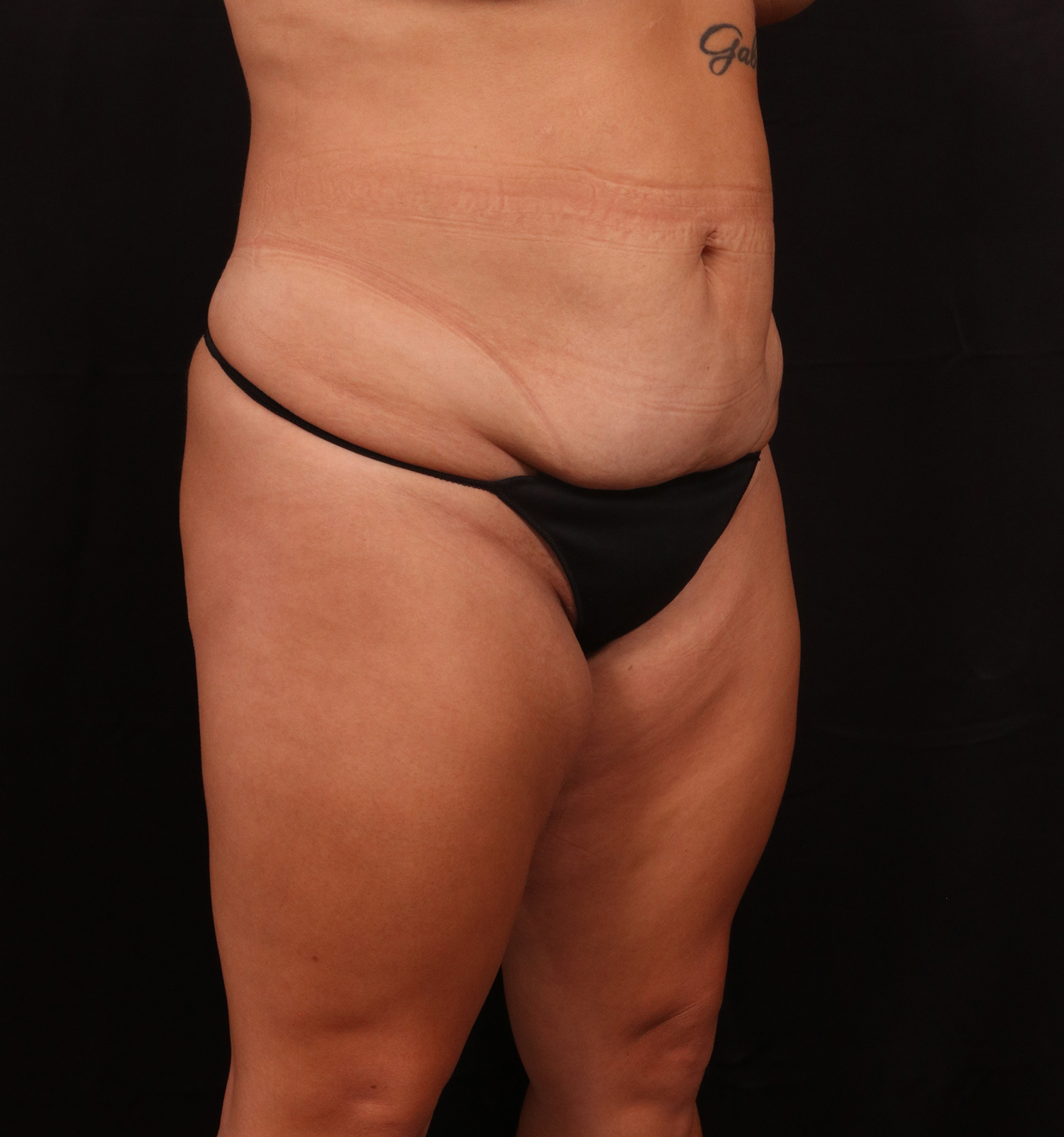 Before Image: Tummy Tuck - right-front-oblique