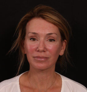 After Image: Facelift with Fat Grafting