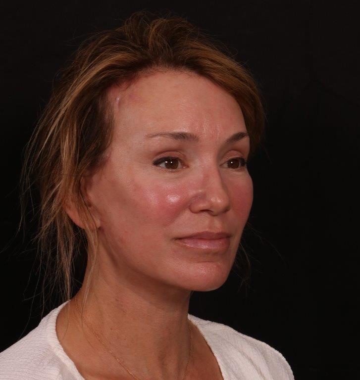 After Image: Facelift with Fat Grafting - right-front-oblique