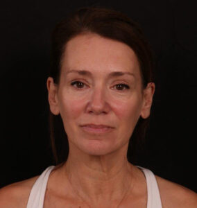 Before Image: Facelift with Fat Grafting