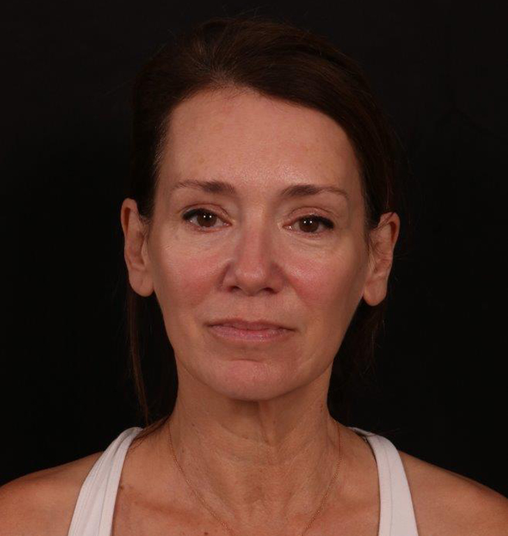 Before Image: Facelift with Fat Grafting - front
