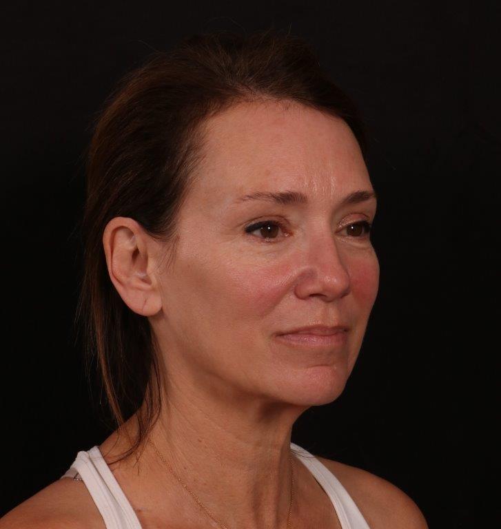 Before Image: Facelift with Fat Grafting - right-front-oblique