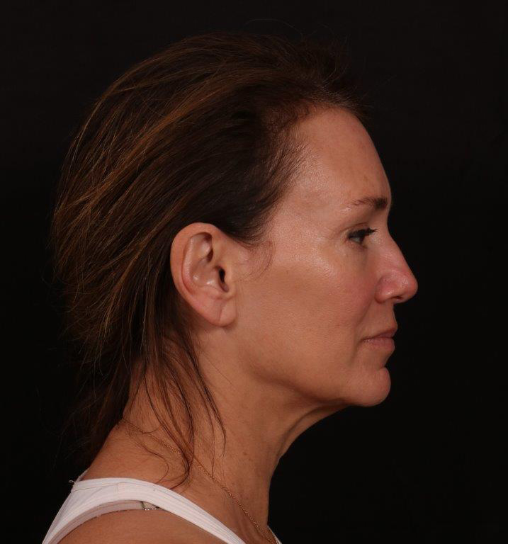 Before Image: Facelift with Fat Grafting - right-side