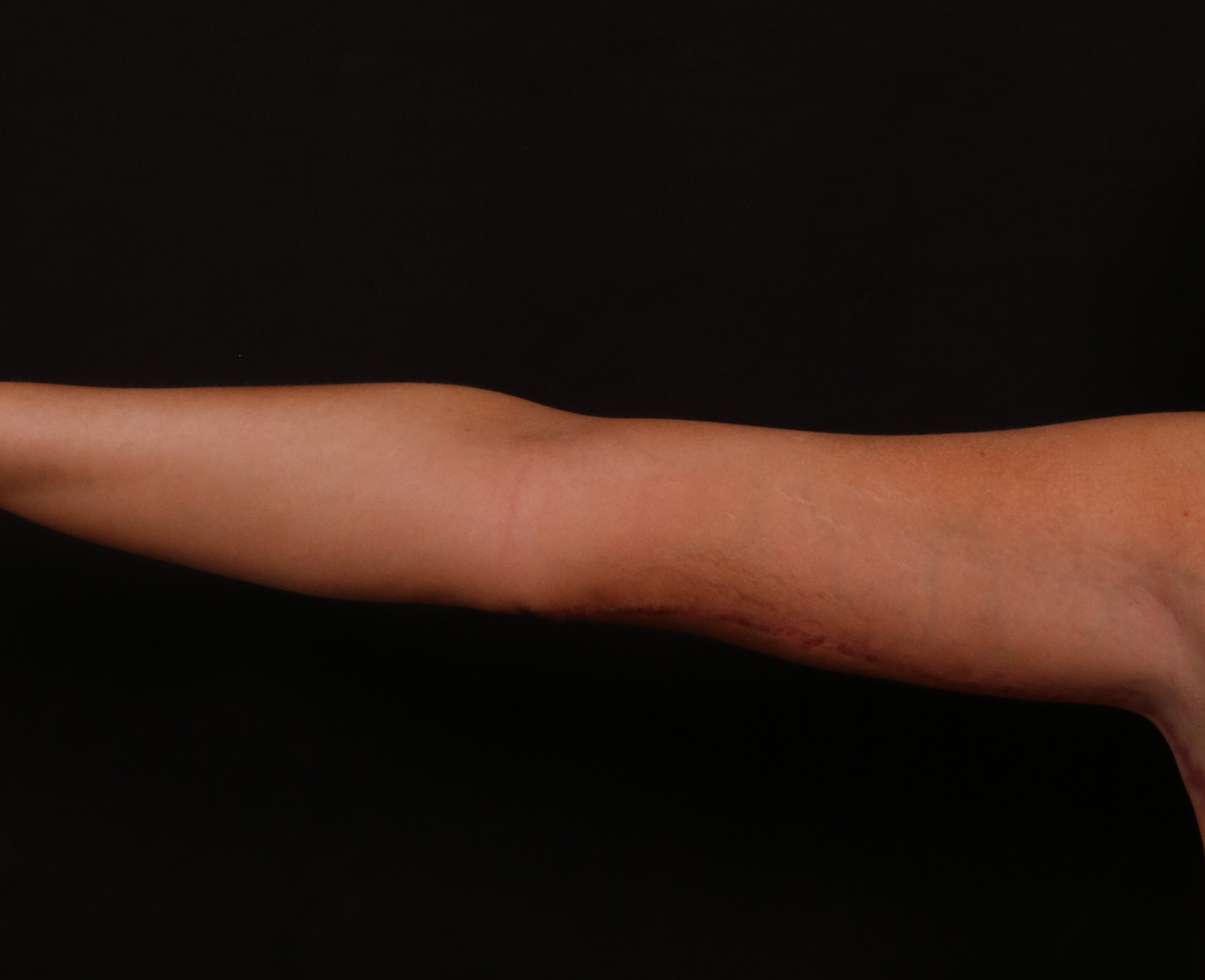 After Image: Brachioplasty - front